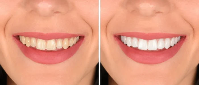 Antes-despues-carillas-dentales-caso-1