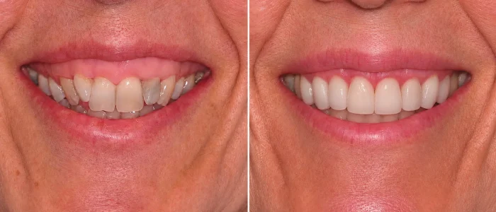 Antes-despues-carillas-dentales-caso-3