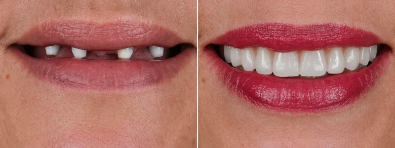 Antes-despues-Implantes-dentales-caso-2
